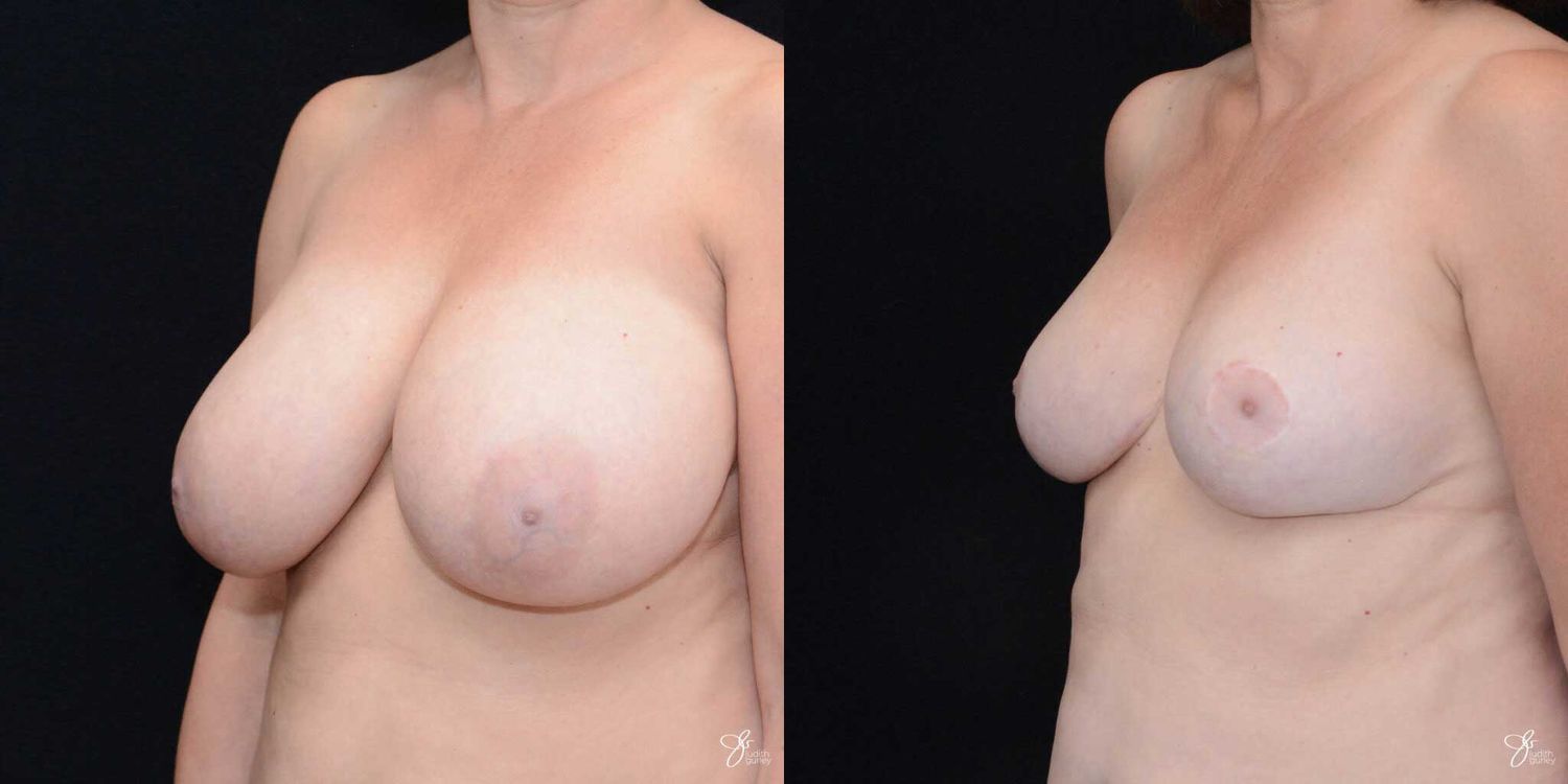 Breast Reduction Before & After