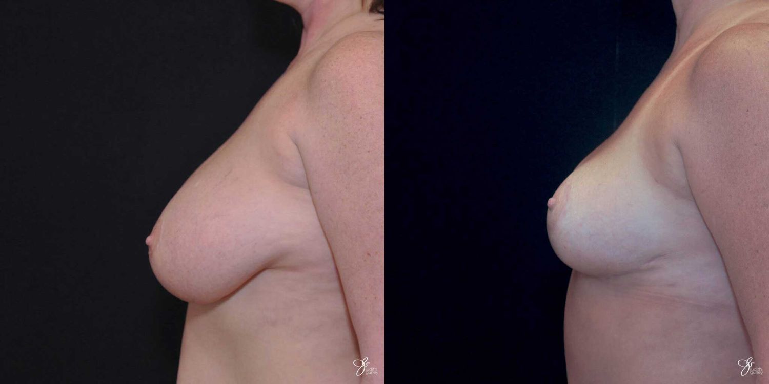 Breast Reduction Before & After