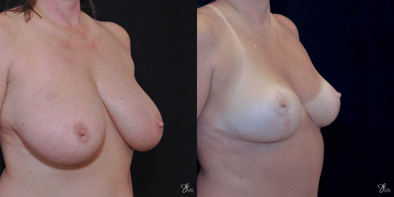 Breast Reduction Before & After