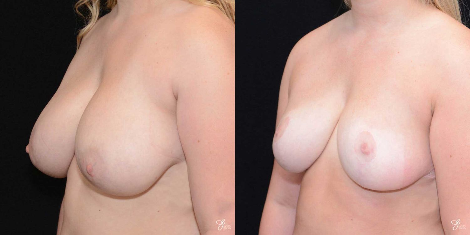 Breast Reduction Before & After