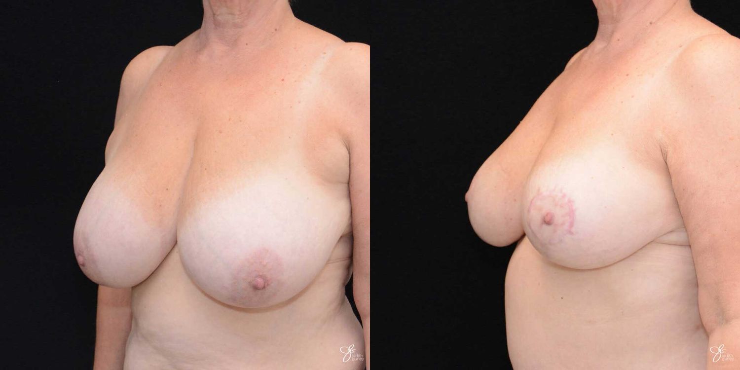 Breast Reduction Before & After
