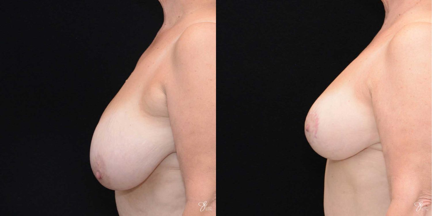Breast Reduction Before & After