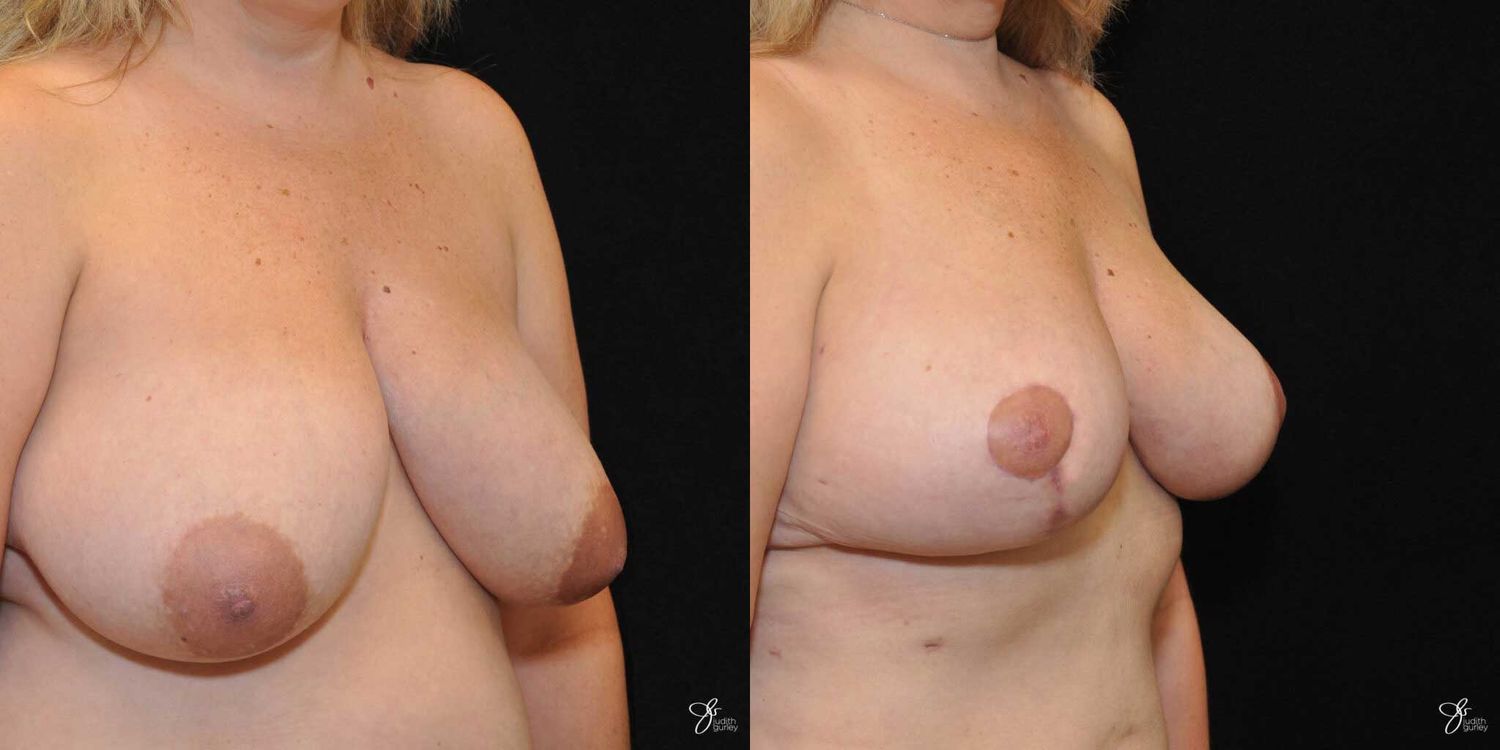 Breast Reduction Before & After