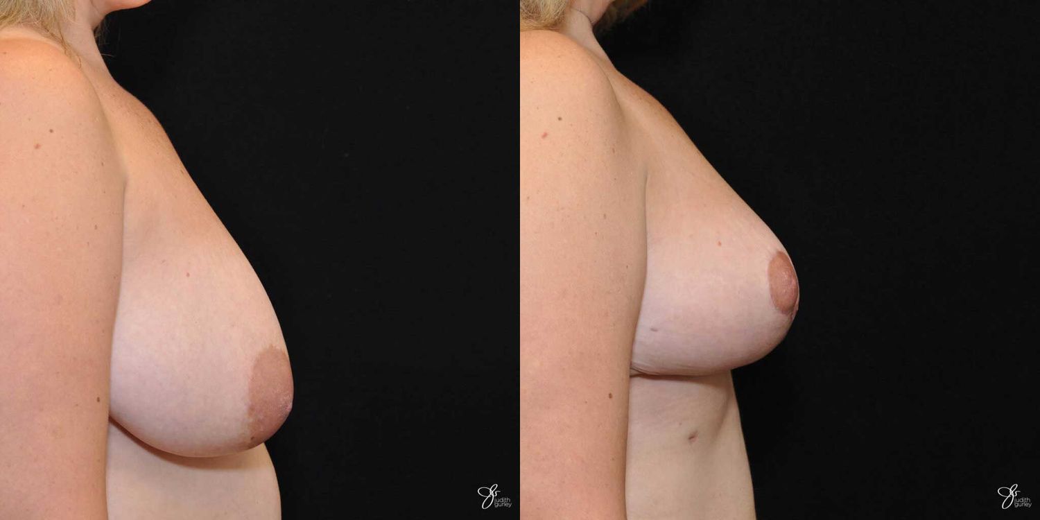 Breast Reduction Before & After
