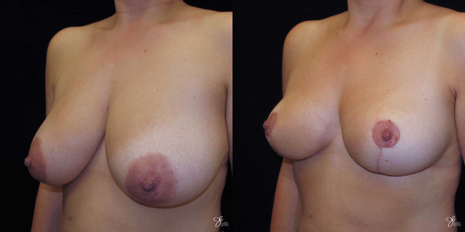 Breast Reduction Before & After