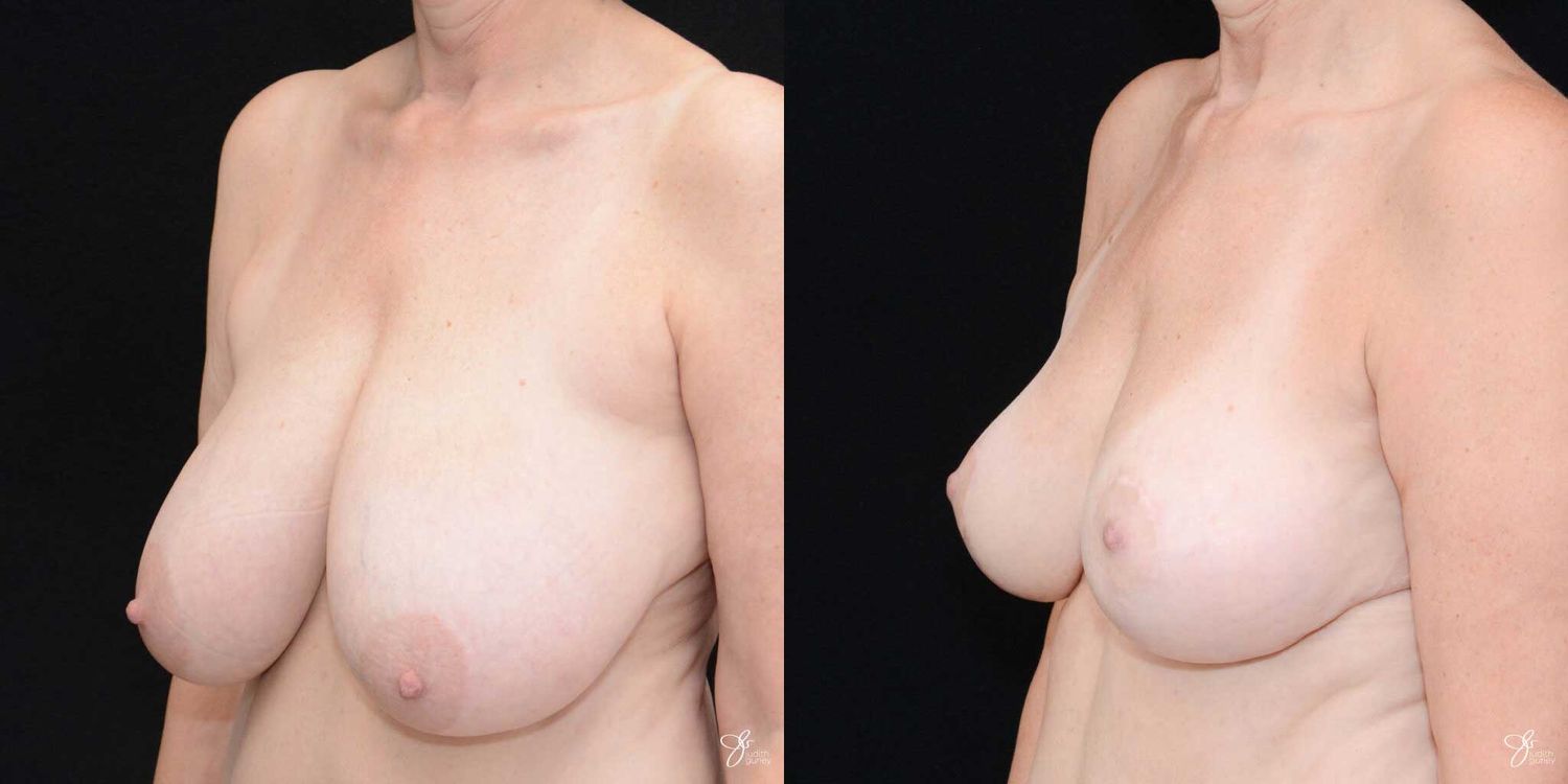 Breast Reduction Before & After