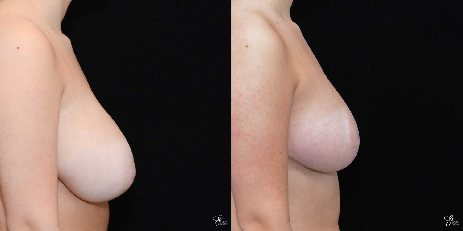 Breast Reduction Before & After