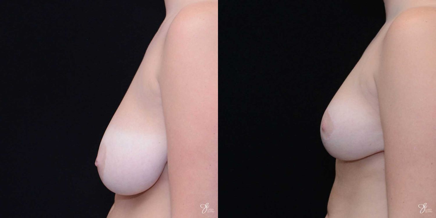 Breast Reduction Before & After