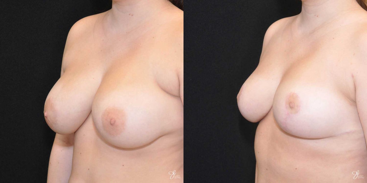 Breast Reduction Before & After