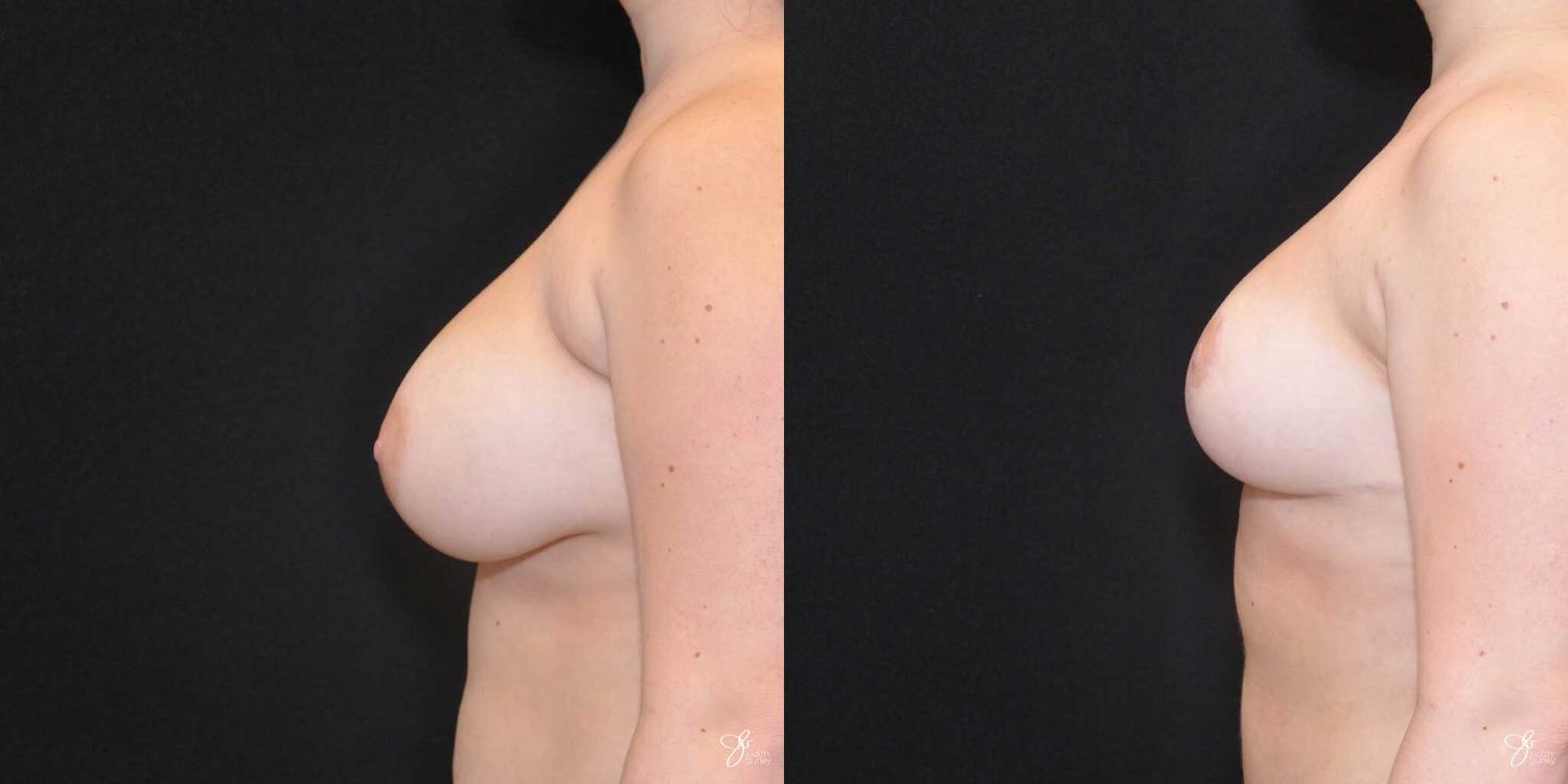 Breast Reduction Before & After
