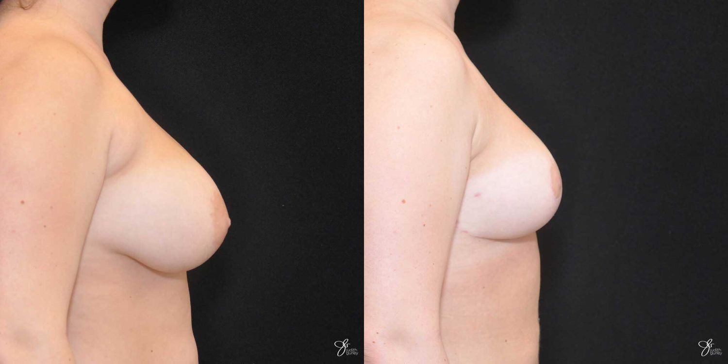 Breast Reduction Before & After
