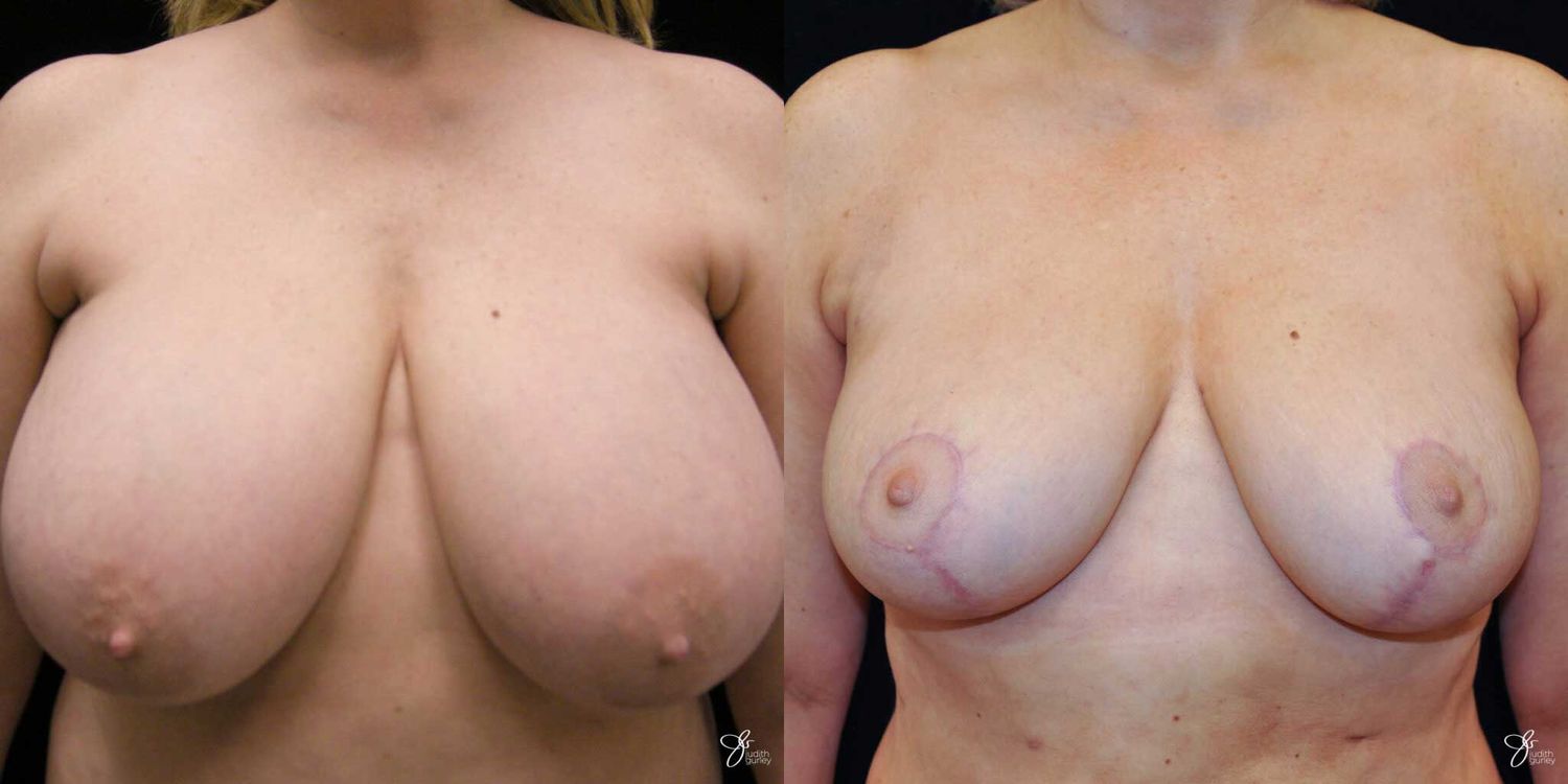 Breast Reduction Before & After