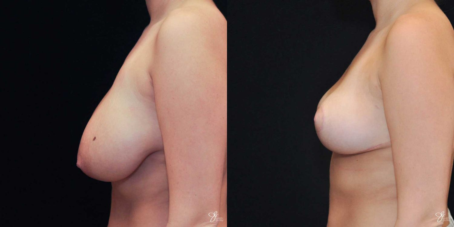 Breast Reduction Before & After