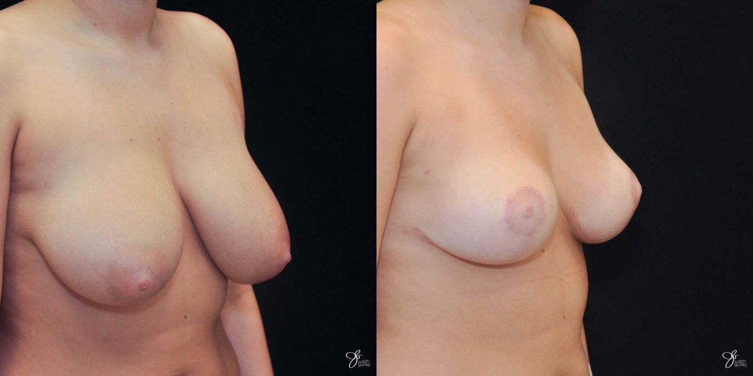 Breast Reduction Before & After