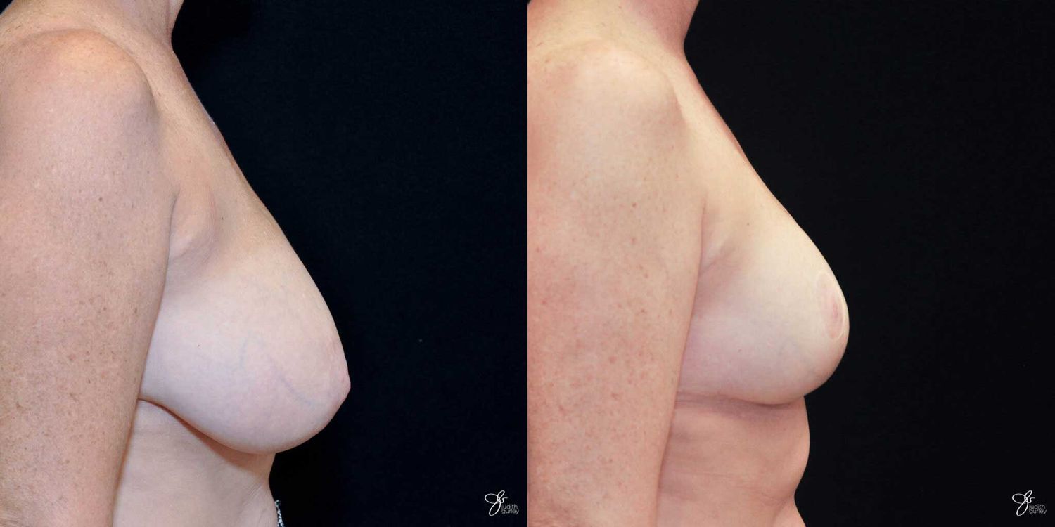 Breast Reduction Before & After