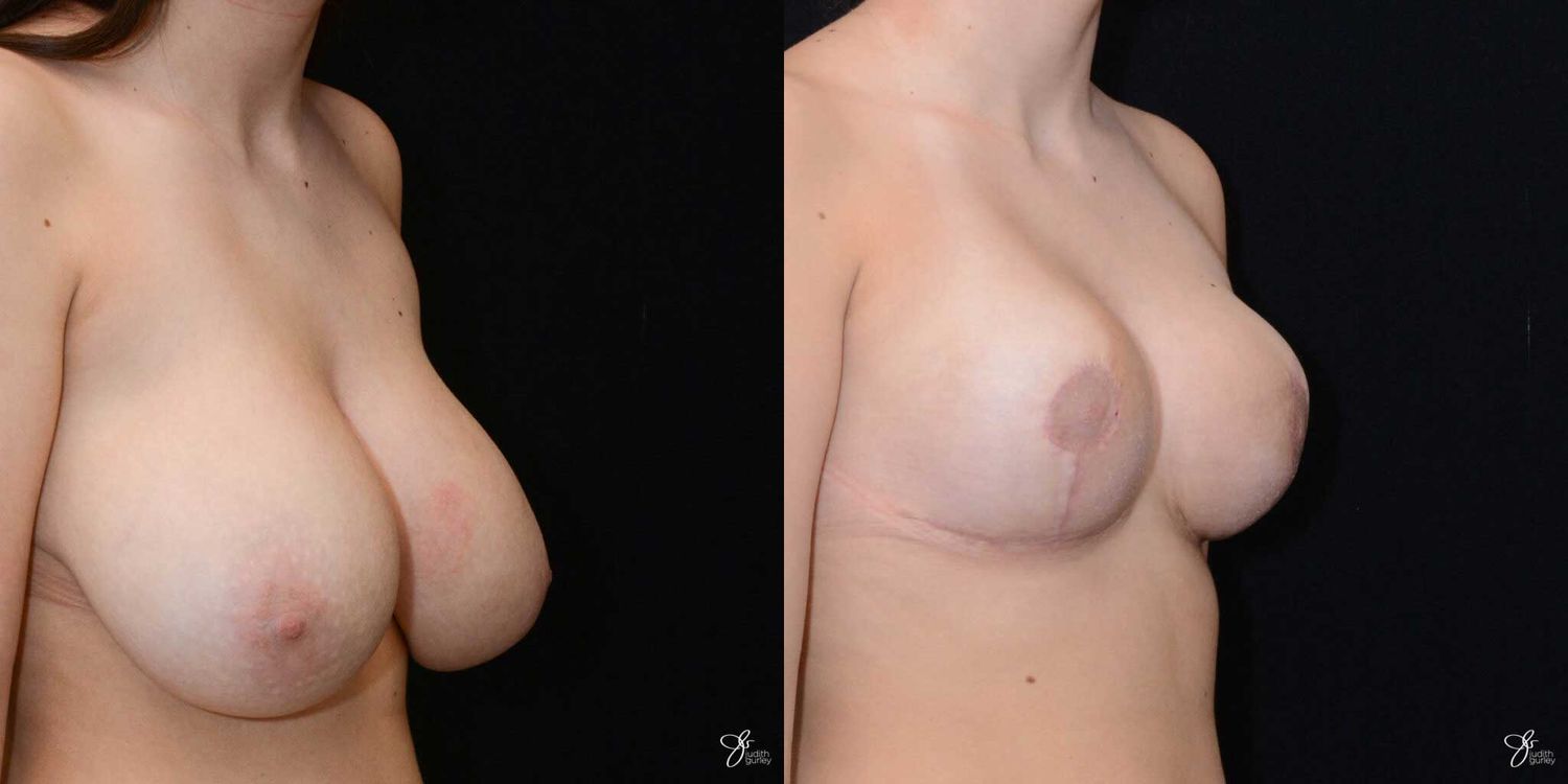 Breast Reduction Before & After