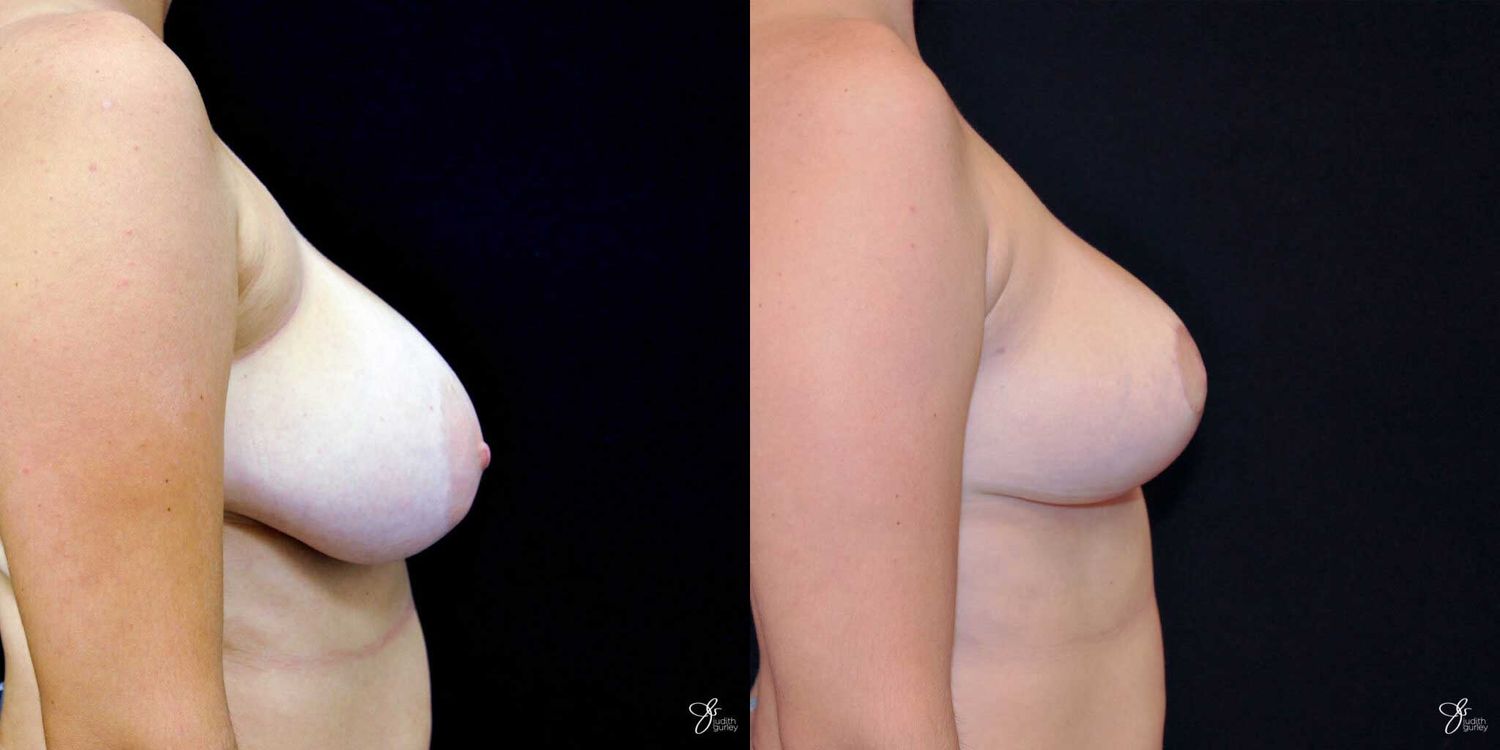 Breast Reduction Before & After