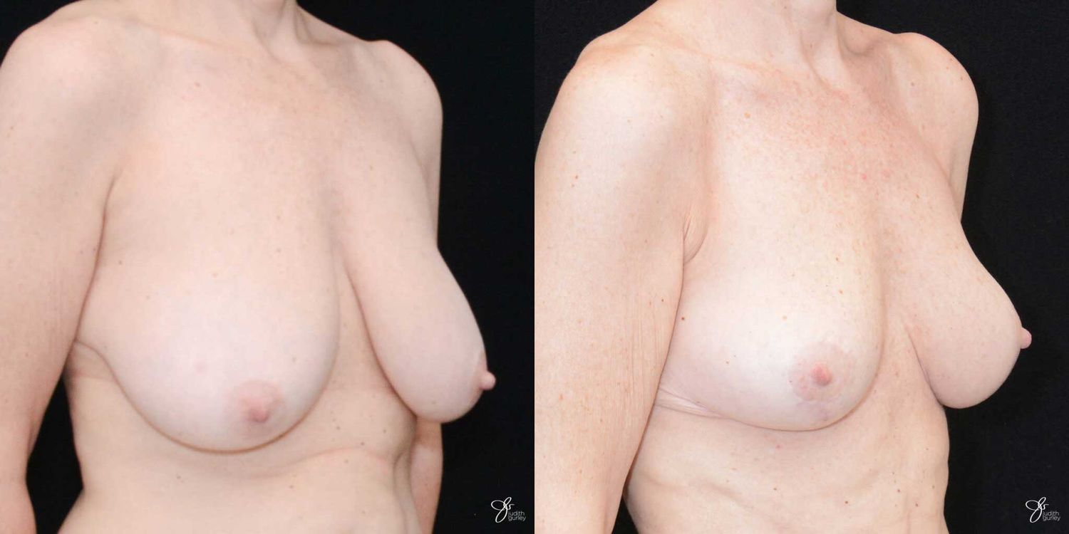 Breast Reduction Before & After