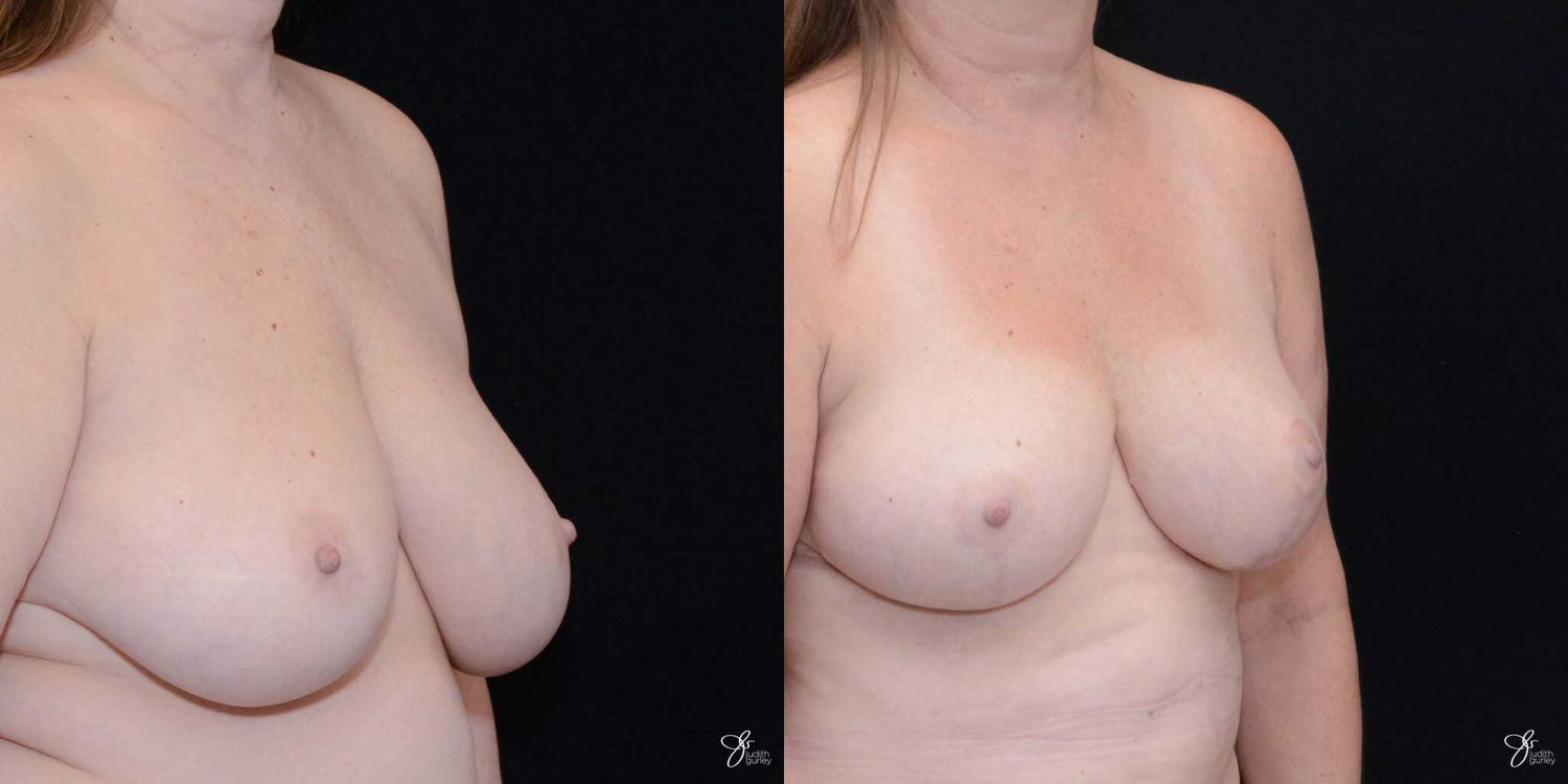 Breast Reduction Before & After
