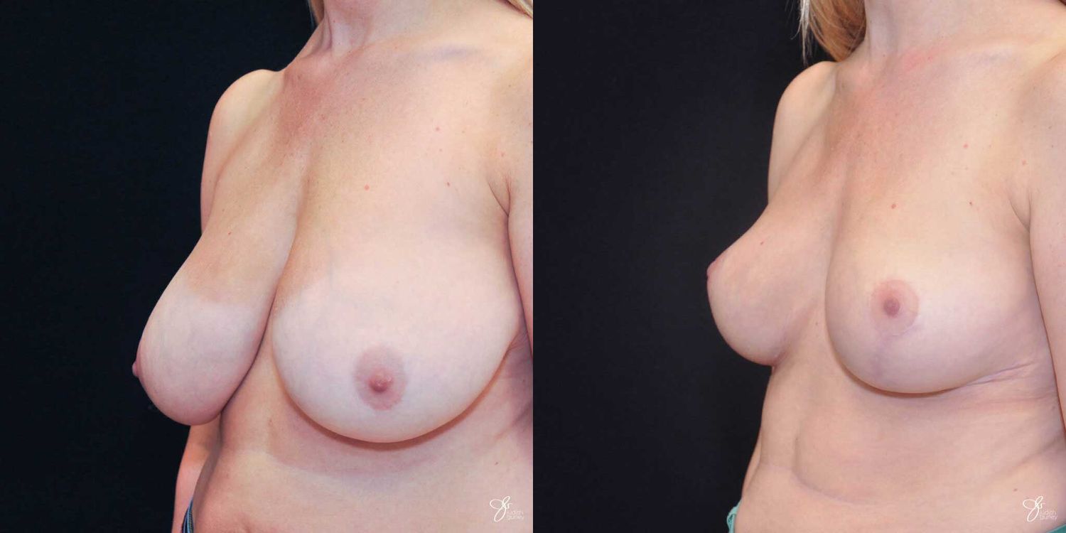 Breast Reduction Before & After