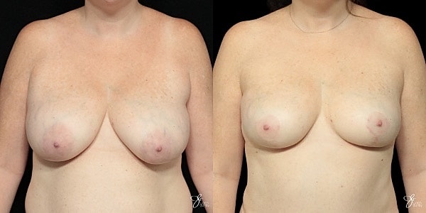 Breast Reduction Before & After