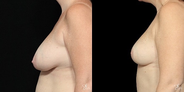 Breast Reduction Before & After
