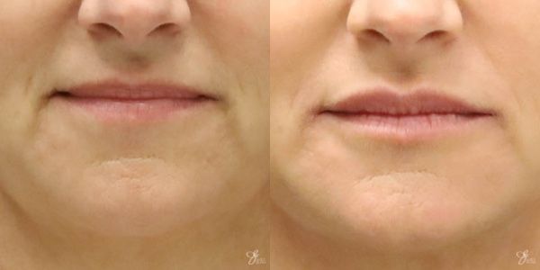 Lip Filler Before & After