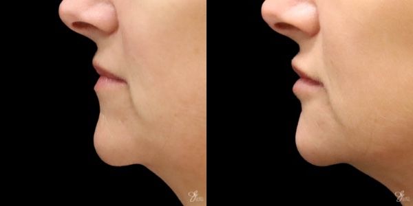 Lip Filler Before & After