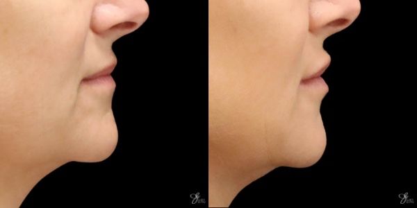Lip Filler Before & After