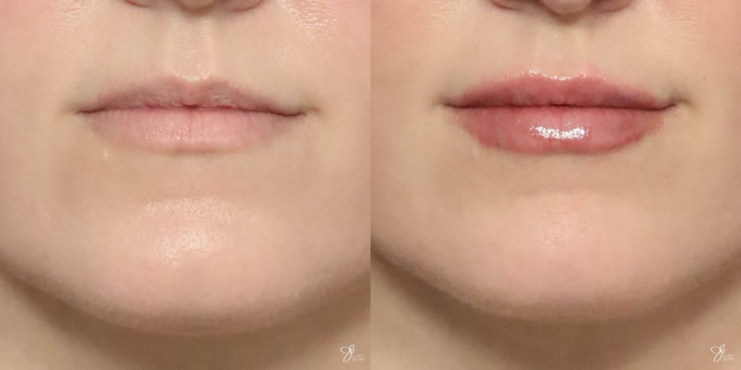 Lip Filler Before & After