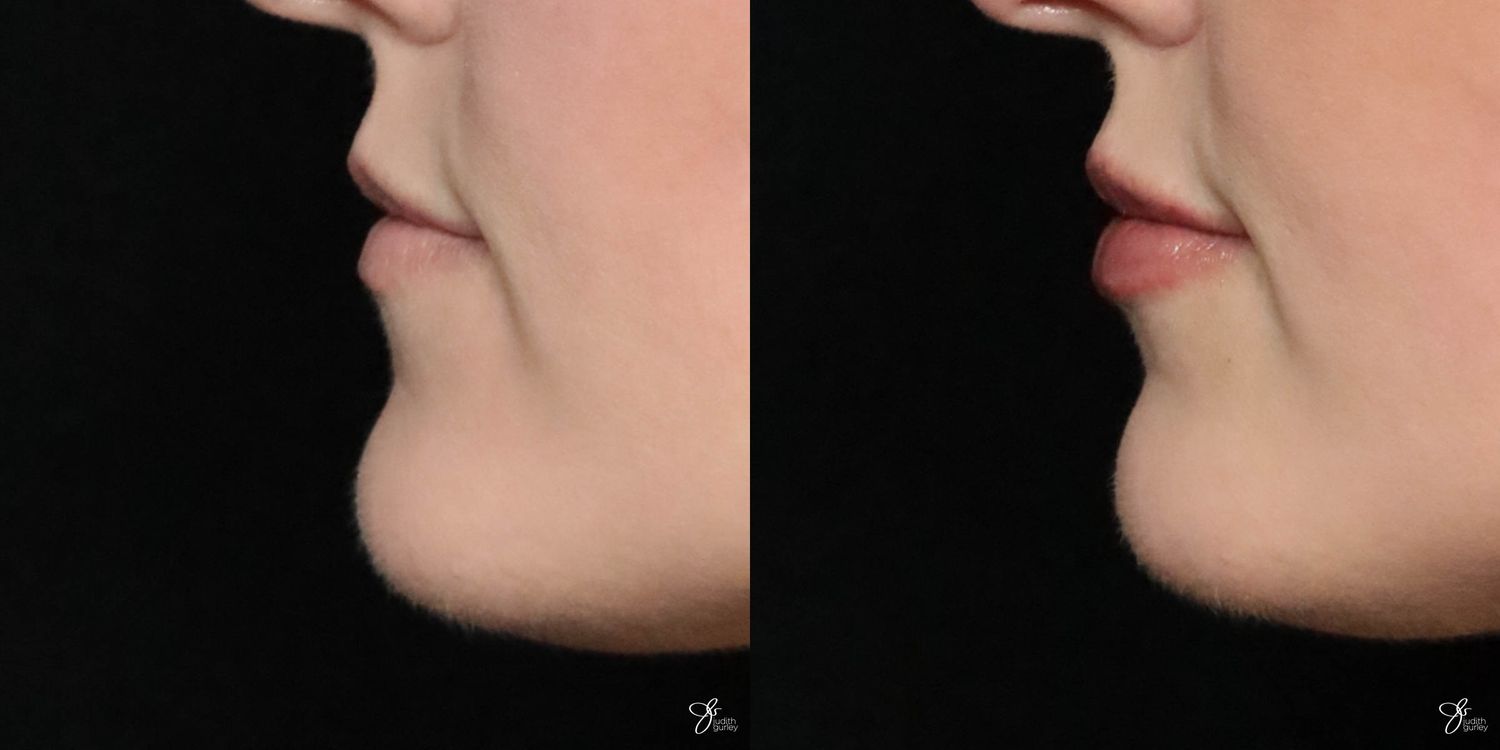 Lip Filler Before & After