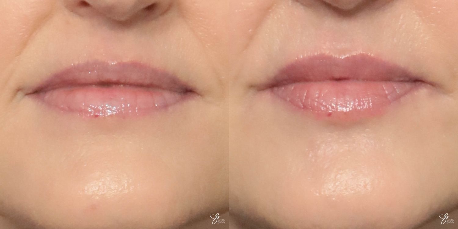 Lip Filler Before & After