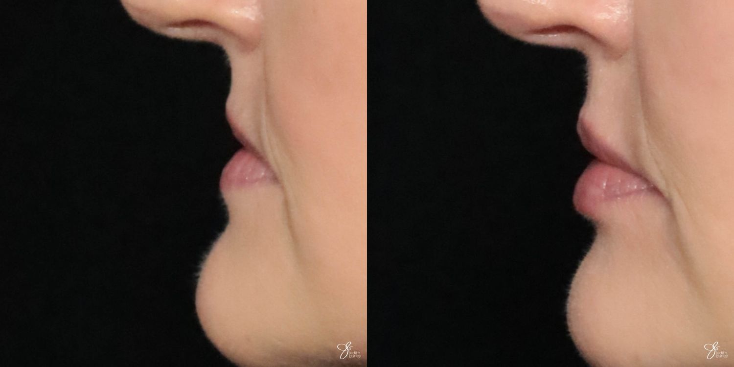 Lip Filler Before & After