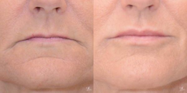 Lip Filler Before & After