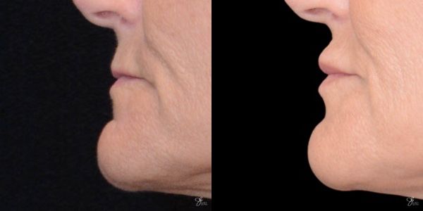 Lip Filler Before & After