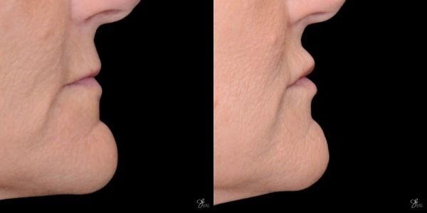 Lip Filler Before & After