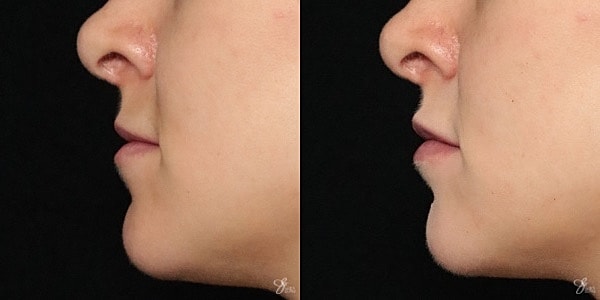 Lip Filler Before & After