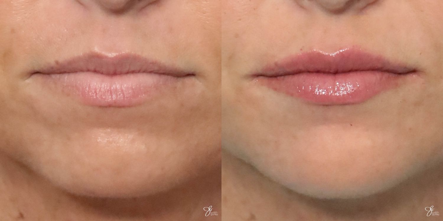 Lip Filler Before & After