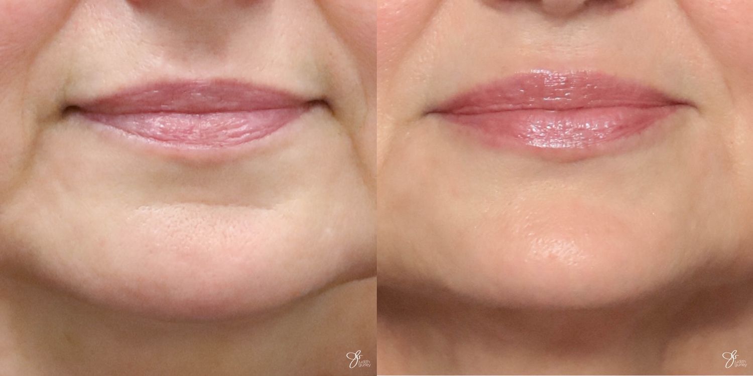 Lip Filler Before & After