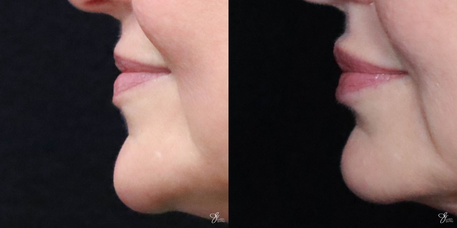 Lip Filler Before & After