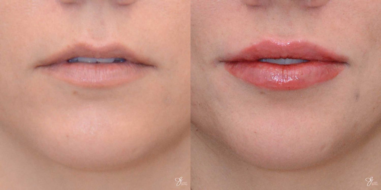 Lip Filler Before & After