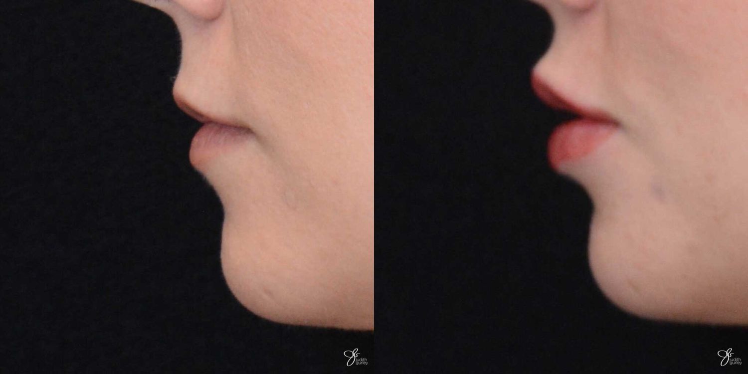 Lip Filler Before & After