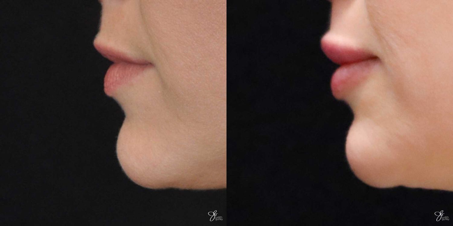Lip Filler Before & After