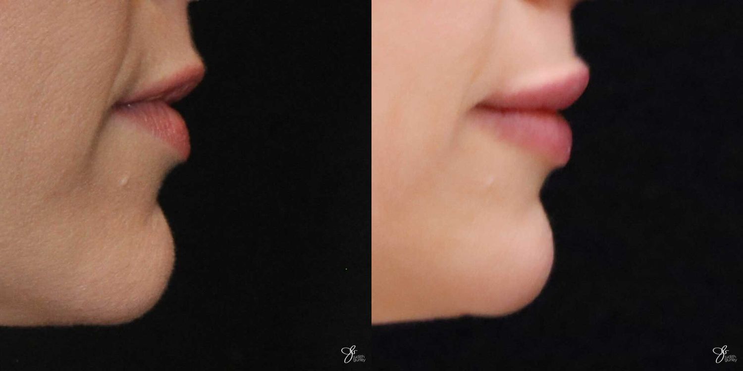 Lip Filler Before & After