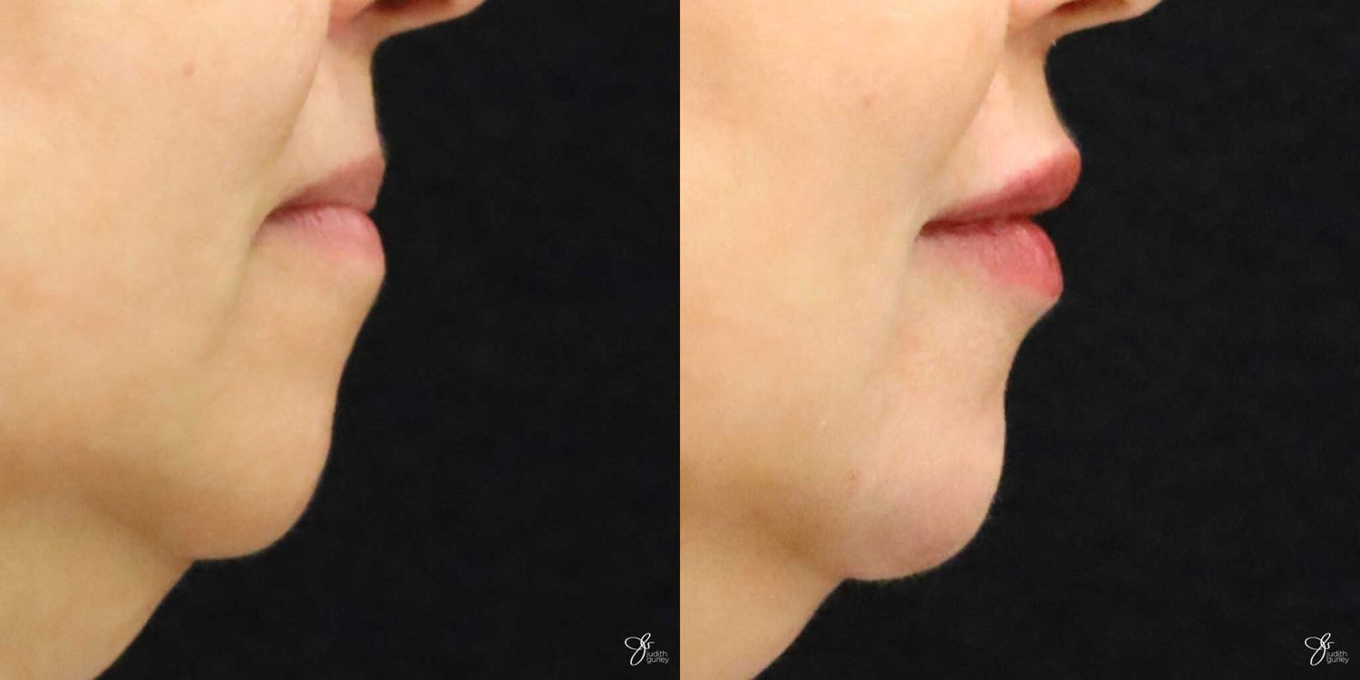 Lip Filler Before & After