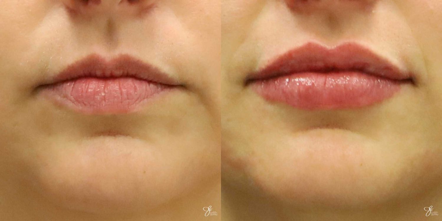 Lip Filler Before & After