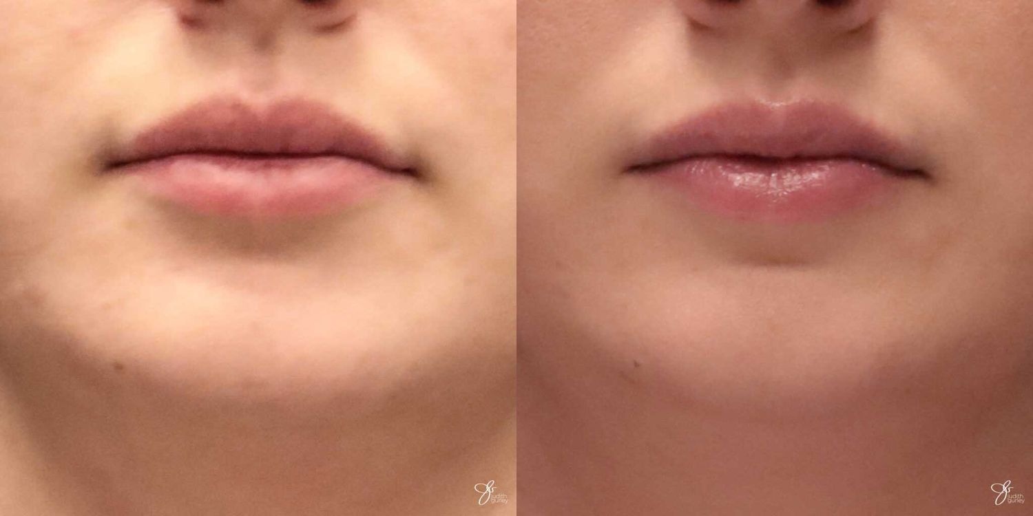 Lip Filler Before & After