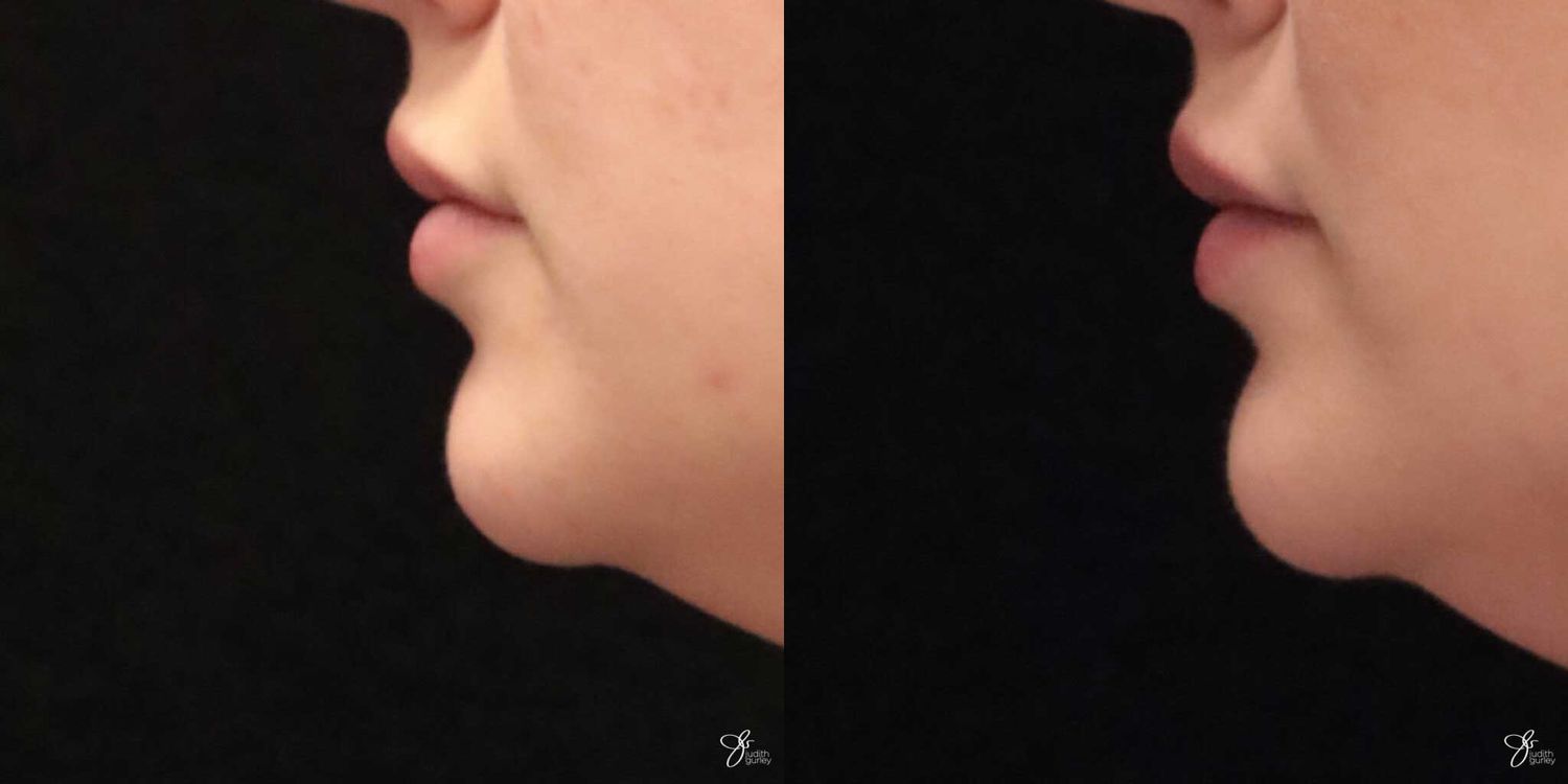 Lip Filler Before & After