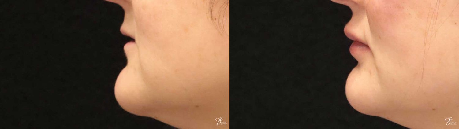 Lip Filler Before & After