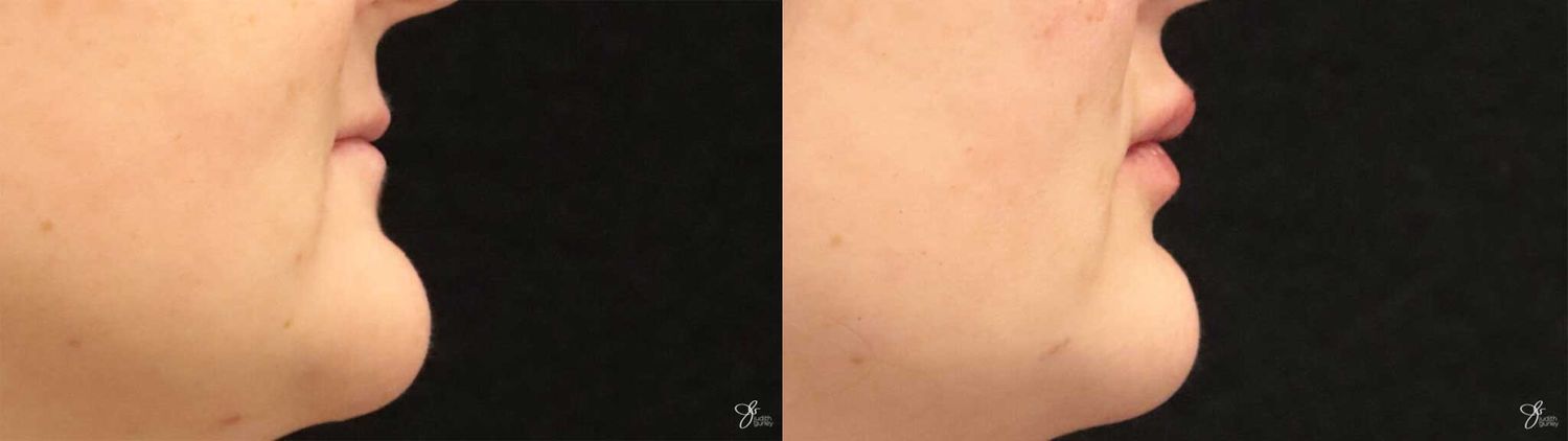 Lip Filler Before & After